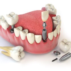 HOW TO CLEAN DENTAL IMPLANTS