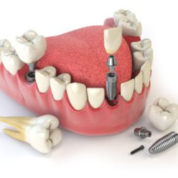 Dental implants example model