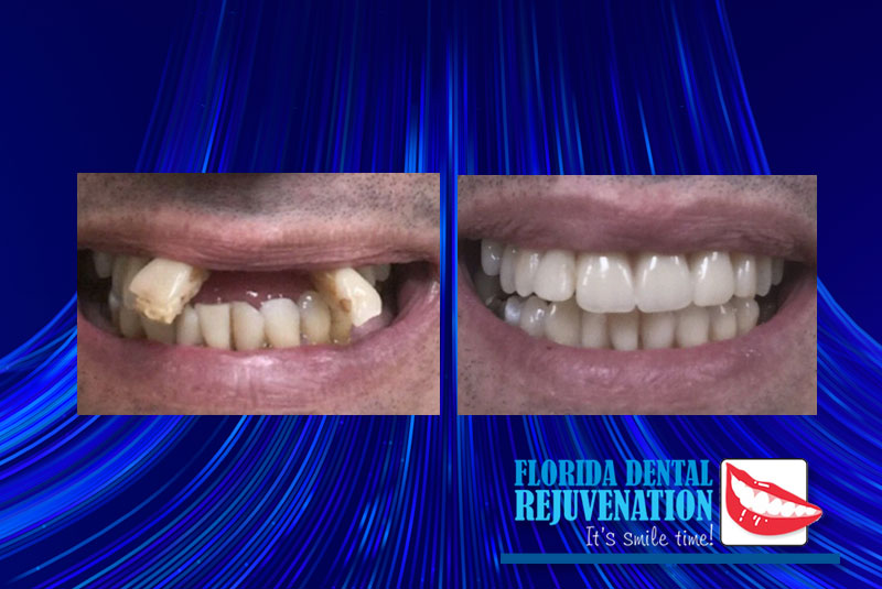 Dental Implant and bridge case 1 florida rejuvenate