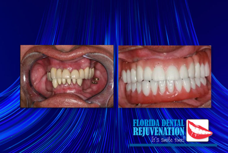 Full Mouth Dental Implants Delray Beach, FL Florida Dental Rejuvenation