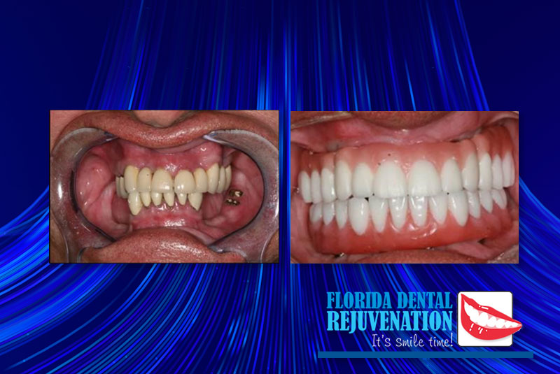 Full Mouth Implant case x florida rejuvenate