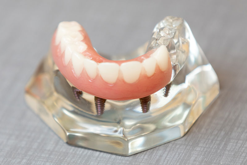 full mouth dental implant on counter