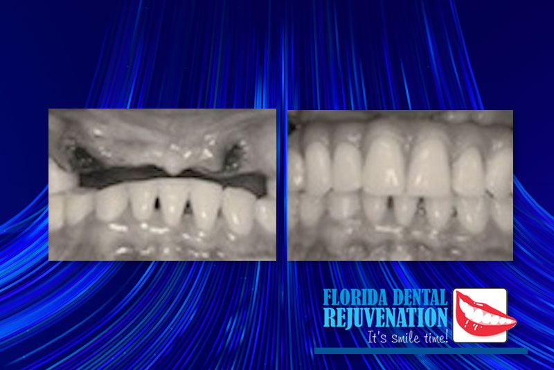 hybrid upper arch prothesis_before and after combined