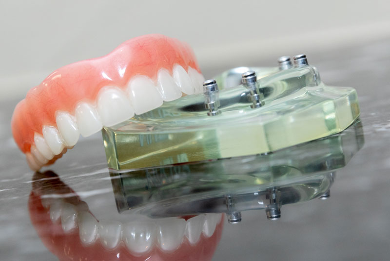implant supported denture on counter top