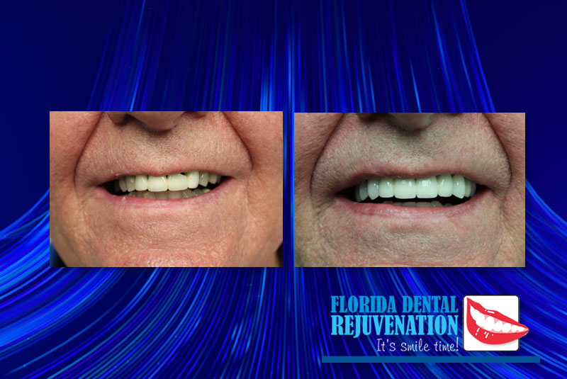 upper arch case x combined Dental Implant and bridge florida rejuvenate