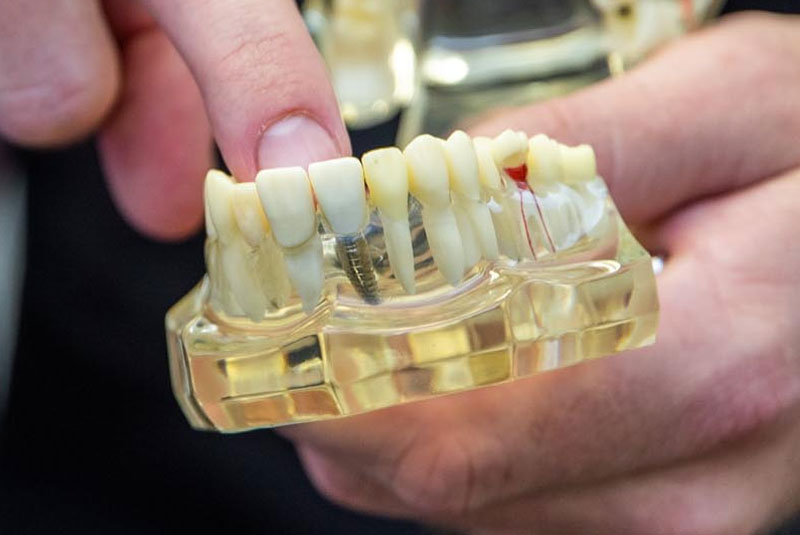 dental implant model being held by dillion