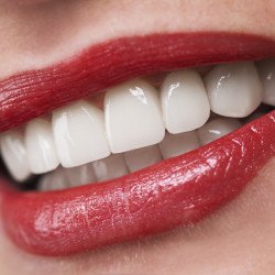 DENTAL IMPLANTS-COSMETIC DENTAL PROCEDURES