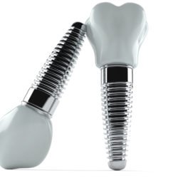 Dental implants example model