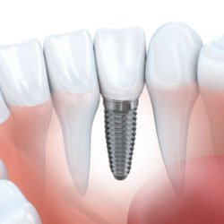 Dental Implant example model
