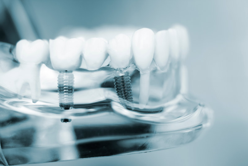 Although Every Person’s Smile Is Unique, What Does A Typical Multiple Dental Implant Procedure Look Like?