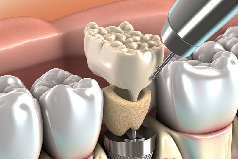 After Getting A Full Arch Of Teeth Extracted, Should I Get Treated With Full Mouth Dental Implants?
